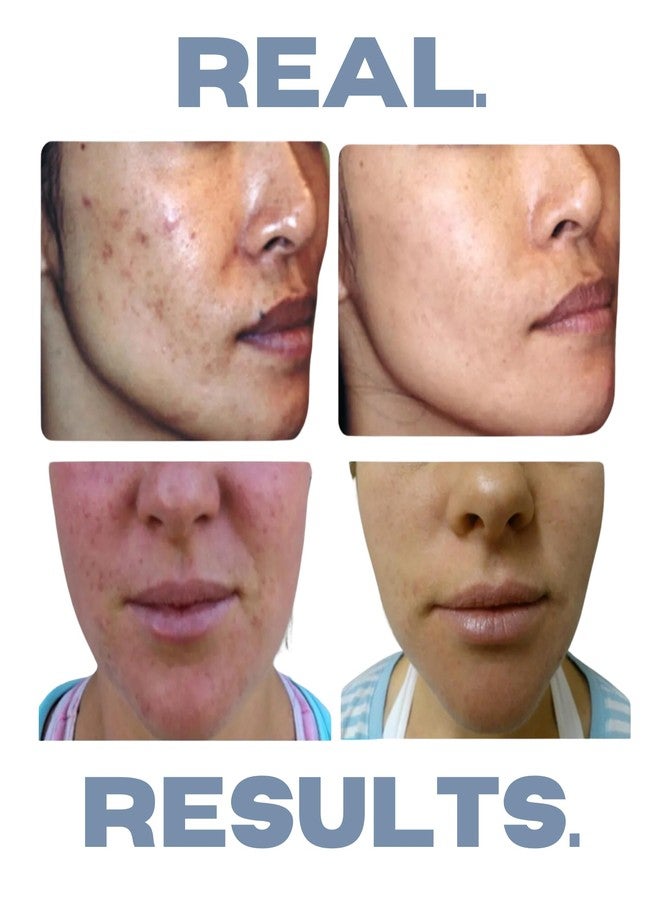 كليروجين مجموعة كليروجين لعلاج حب الشباب، مجموعة علاج حب الشباب، العناية بالبشرة المعرضة لحب الشباب، مجموعة العناية بالبشرة المعرضة لحب الشباب، مجموعة طبيعية فاخرة مضادة لهرمون ديهدروتستوستيرون للبشرة الحساسة، مجموعة من 3 قطع، تكفي لمدة شهر واحد - Image 2